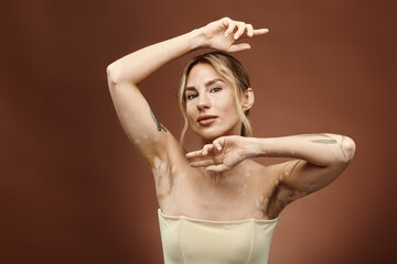 Naklejka premium A young woman with vitiligo poses confidently, showcasing her tattoo and embracing her unique beauty.