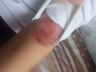 Allergy on the hand. A bloody wound. Atopic dermatitis. Skin diseases.