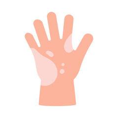 Vitiligo on skin of hand of child. Body with area pigmentation different color. Autoimmune disease. Vector