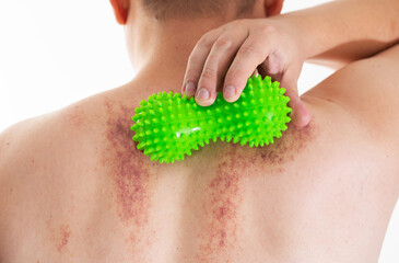 A man holds a green massage roll near his back. Red spots on the skin from improper self-massage,...