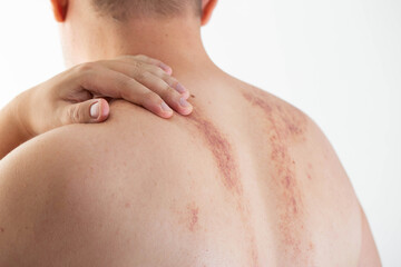 Marks on the skin of a man's back after a massage. Concept of improper massage, bruising and skin...