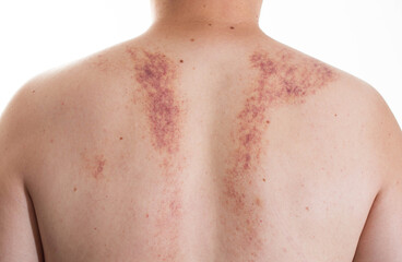 Marks on the skin of a man's back after a massage. Concept of improper massage, bruising and skin...