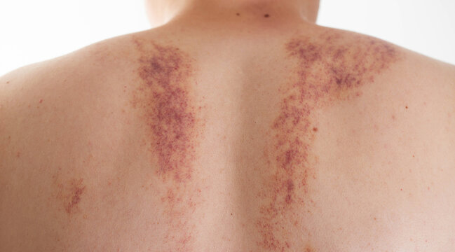 Marks on the skin of a man's back after a massage. Concept of improper massage, bruising and skin irritation, close-up