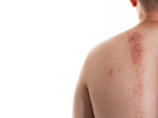 Naklejka premium The skin of a man's back with red spots, marks on the skin and bruises after improper massage, close-up. Copy space for text