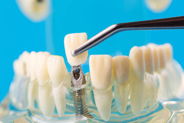 A dental crown made of metal ceramics in tweezers against the background of a medical model of the...