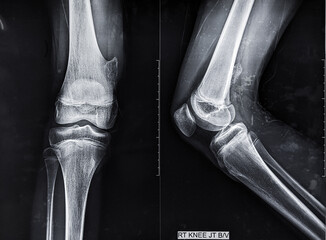 X Ray image of osteochondroma, most common benign bone tumour 