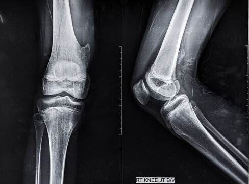 X Ray image of osteochondroma, most common benign bone tumour 