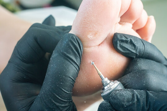 A podologist removes a rod callus on a woman's foot with an electric pedicure drill