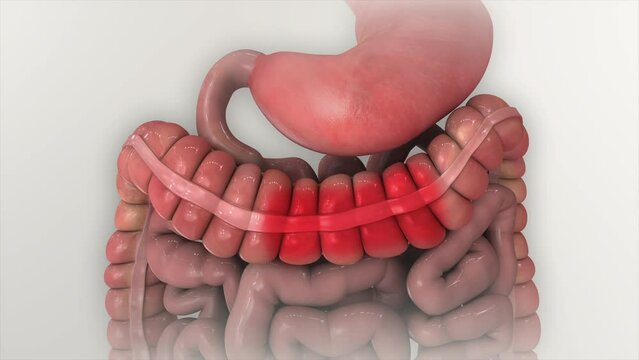 IBS Irritable Bowel Syndrome