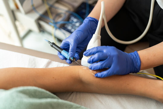 Percutaneous electrolysis treatment on arm.