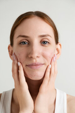Young Woman with Acne Touching Her Face

