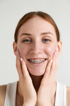 Smiling Young Woman with Acne and Braces