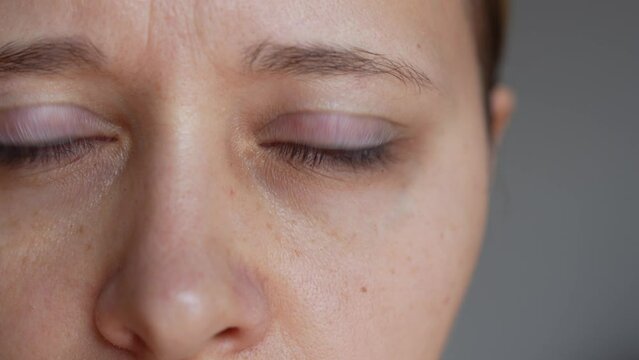 A young caucasian woman demonstrating dark circles under her eyes with hand on a dark grey background. Pale skin, bruises under the eyes are caused by fatigue, lack of sleep, insomnia and stress