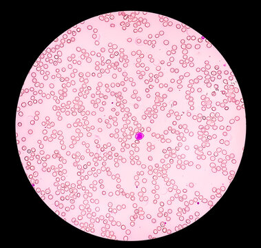 Photomicrograph showing Aplastic anemia, a rare but serious blood condition that occurs when bone marrow can not make enough new blood cells in body.