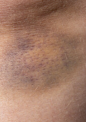 Fototapeta premium hematoma on the leg as a background.