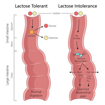lactose tolerance and intolerance, normal digestion with lactase and symptoms from bacterial fermentation diagram hand drawn schematic vector illustration. Medical science educational illustration