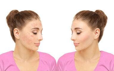 Post-Acne Marks /Treating Acne Scars.Acne Scar Removal.