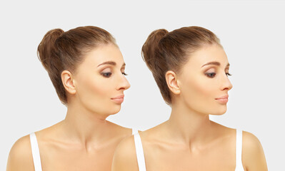 face beauty, nose and chin correction, rhinoplasty, genioplasty,Chin augmentation