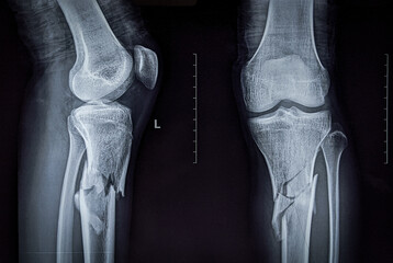 X ray image showing comminuted fracture of upper part of shaft of tibia 