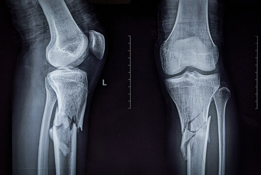 X ray image showing comminuted fracture of upper part of shaft of tibia 