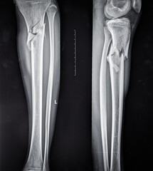 X ray image showing comminuted fracture of upper part of shaft of tibia 