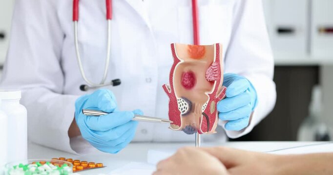 Anatomy of anus and intestines. Treatment of diseases of rectum hemorrhoids. Proctologist and rectal pathology on anatomical model concept