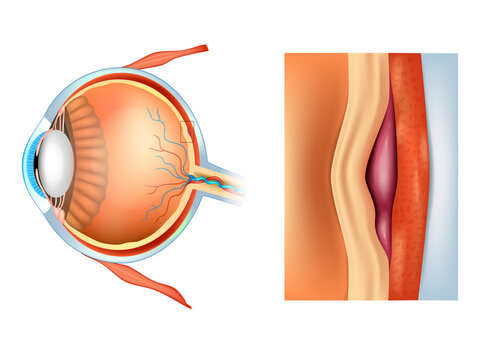 Macular degeneration, also known as age-related macular degeneration.AMD or ARMD. Medical condition which may result in blurred or no vision in the center of the visual field.Damage to the macula