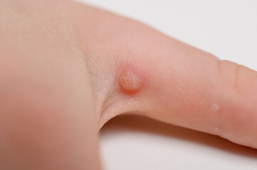 Close-up of common wart Verruca vulgaris on child hand. Large flat wart on finger. HPV infection. Wart removal concept