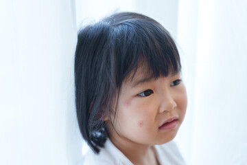 顔を虫刺された子供