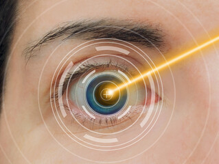 Close-up of blue eye with digital guides treated with yellow diode laser beam surgery process for...