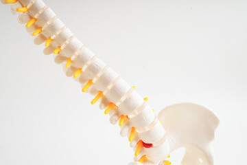 Spinal nerve and bone, Lumbar spine displaced herniated disc fragment, Model for treatment medical in the orthopedic department.