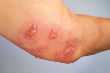 Fototapeta premium Shingles, Zoster or Herpes Zoster symptoms on arm.