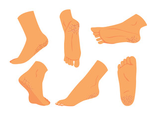 Set of callus cracked heels or feet, labelled plantar hyperkeratosis, Feet corns and calluses, medical condition, barefoot or foot fungus with various view or angles, isolated on white background