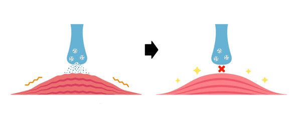 Mechanism of muscle relaxation by Botox. Vectror illustration.