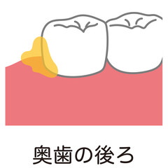 奥歯の後ろに溜まった歯垢　歯磨き　磨き残し