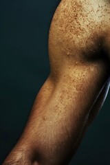 Male arm shows eczema dermatitis symptoms with itchy dry skin and insect bites. Close-up view of allergic reaction on brown skin with dirt specks. Dark blue background contrasts with arm color.