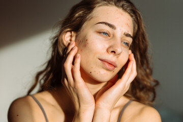 Fototapeta premium Woman with problem skin on her face. Medicine and cosmetology concept. Natural skin.