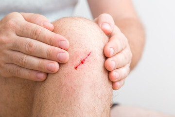 Young adult man hands touching leg with red abrasion bleeding knee skin after fell down. Closeup. Front view.