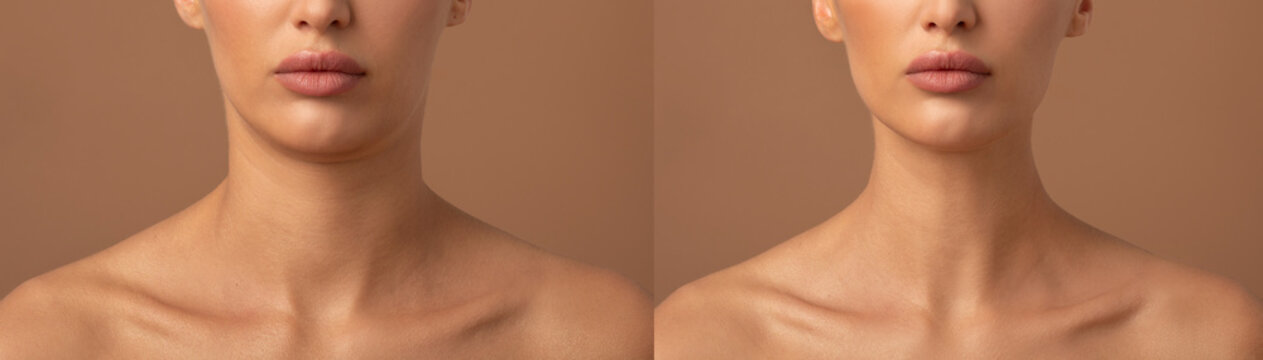 Double chin lift. Female before and after plastic surgery, mentoplasty or facebuilding. Chin fat removal and face contour correction concept