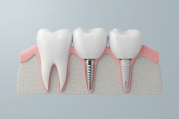 Comparison of Titanium and Zirconia Dental Implant Types. 3D Rendering
