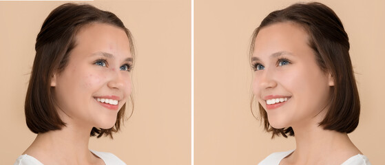 Beautiful young happy woman with acne problem on beige background