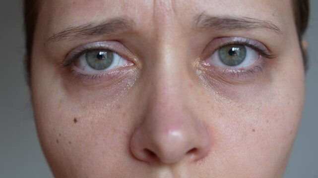 A sad young caucasian woman demonstrating dark circles under her eyes with hand on a dark grey background. Pale skin, bruises under the eyes are caused by fatigue, lack of sleep, insomnia and stress