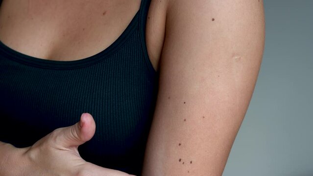 Cropped shot of a young woman with a large number of moles on her arms on a grey background. The effect of sunlight on the skin