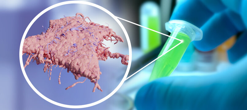 Infected sample concept, cancer cell infection presence, lung cancer and lung disease, tuberculosis Department samples in the lab