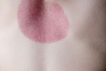Red spots on the back of a little boy after cupping procedures, rear view. High quality photo
