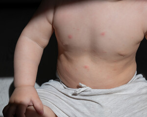 Allergy on the body of a little baby boy. 