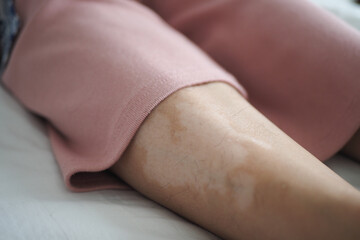  feet with vitiligo skin condition.