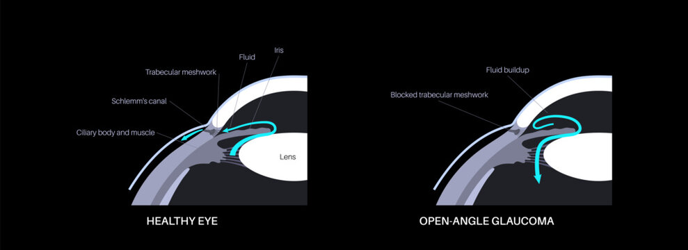 Glaucoma eye disease