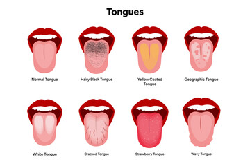 Normal, hairy black, yellow coated, geographic, white, cracked, strawberry, wavy tongues  © Oksana