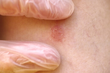 A dermatologist examining a psoriasis plaque on the leg of a patient. Close up.